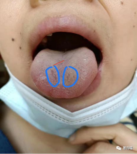 Basic Tongue Diagnosis - Tongue Body and Tongue Coating