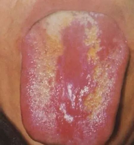 Comprehensive Guide to Tongue Diagnosis and Associated Conditions in TCM