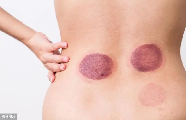 The Art of Cupping in Traditional Chinese Medicine: 5 Contraindications and Analysis of Cupping Marks