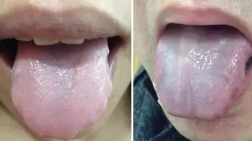 What Does Traditional Chinese Medicine Observe in the Tongue? Nine Body Types and Valuable Tongue Diagnosis Charts!