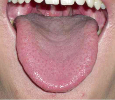 Understanding Health Through Tongue Observation: It's Not as Difficult as You Think