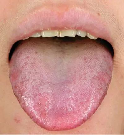 Blood Stasis and Its Impact on Health: How to Care for Individuals with Blood Stasis Constitution