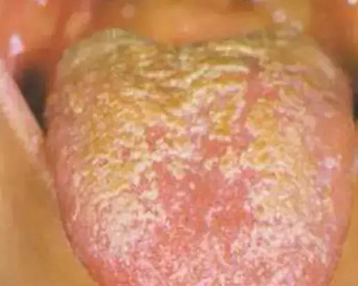 The Most Comprehensive Guide to Tongue Diagnosis! Master It and Become a Tongue Diagnosis Expert