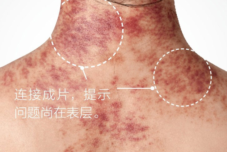 Understanding the Signs of Gua Sha: Master These 5 Colors and 4 Shapes for Better Health