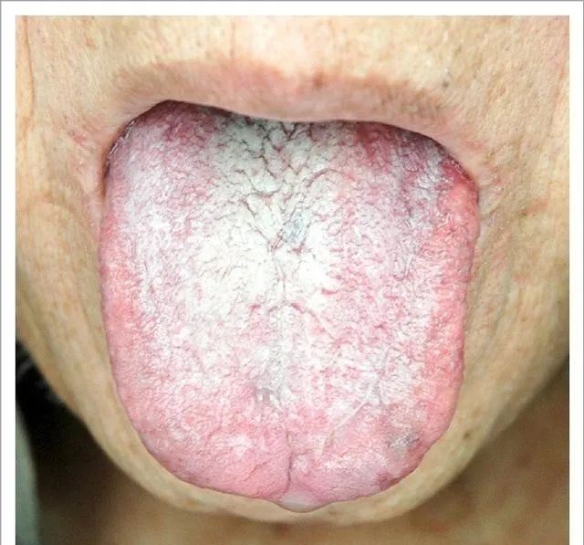 Traditional Chinese Medicine Tongue Diagnosis: 26 Clinical High-Definition Tongue Diagnosis Images with Analysis