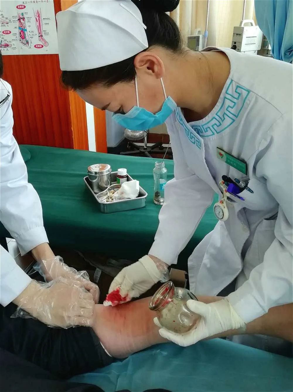 Treatment of Post-Stroke Sequelae with Bloodletting Therapy