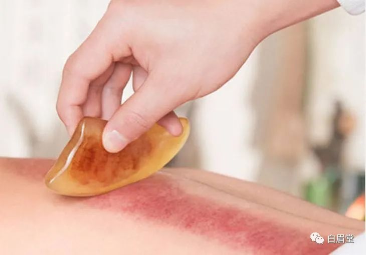 The Origins, Techniques, and Precautions of Gua Sha (Gua Sha: A Localized Method to Improve Circulation, Delay Aging, Promote Qi and Blood Flow, and Alleviate Pain)