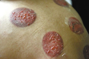 Techniques for Cupping Therapy