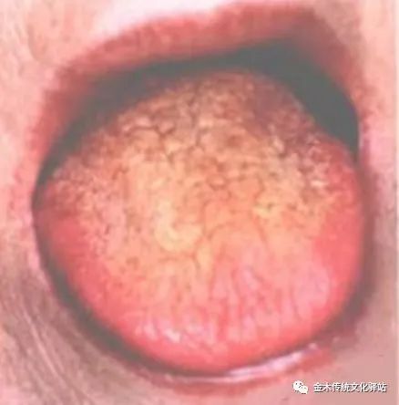 Tongue Diagnosis in Traditional Chinese Medicine: Tongue Coating