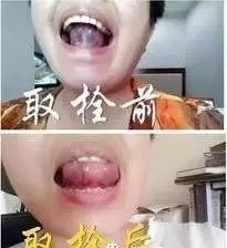 Bloodletting Therapy in Traditional Chinese Medicine: A Quick Cure That Can Save Lives
