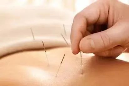 Understanding Fire Needle Therapy in Traditional Chinese Medicine