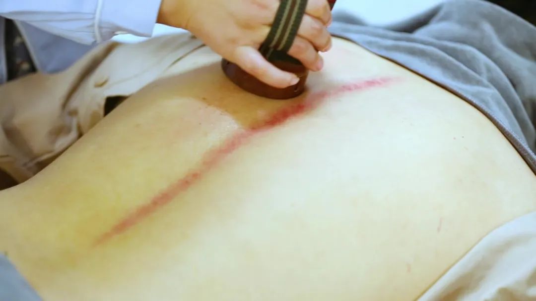 Gua Sha: A Gentle Scraping Technique to Regulate Qi and Blood, Boost Immunity!