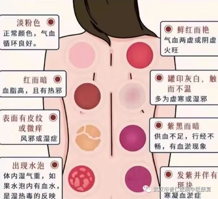 Understanding Youzonguan (Cupping Therapy) in Traditional Chinese Medicine