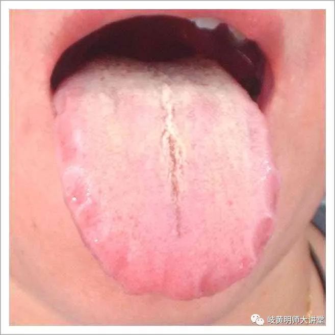 Traditional Chinese Medicine Tongue Diagnosis: Illustrated Guide to 14 Types of Tongue Shapes and Qualities