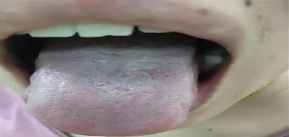 Traditional Chinese Medicine: Two Methods to Assess Blood Stasis and One Herbal Formula to Resolve It