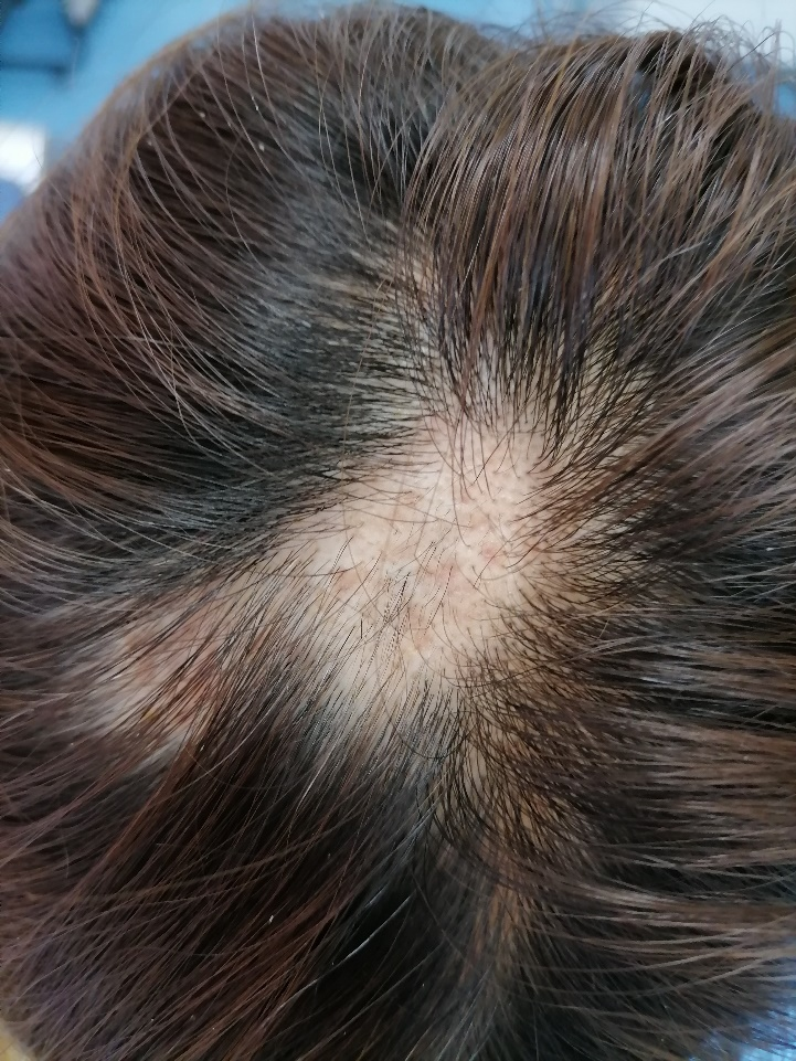 Fire Needle Therapy for Alopecia Areata in Traditional Chinese Medicine