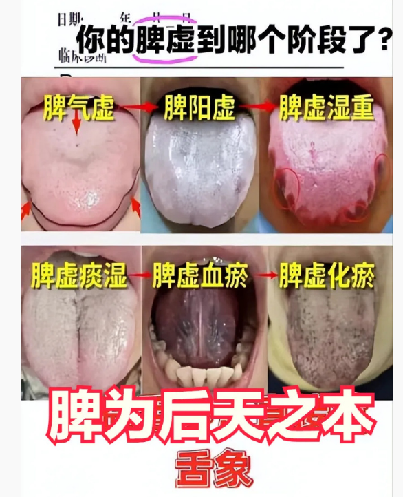 Five Stages from Spleen Qi Deficiency to Blood Stasis: What Are the Changes in Tongue Appearance?