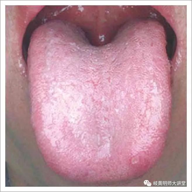 Traditional Chinese Medicine Tongue Diagnosis: Illustrated Guide to 14 Types of Tongue Shapes and Qualities