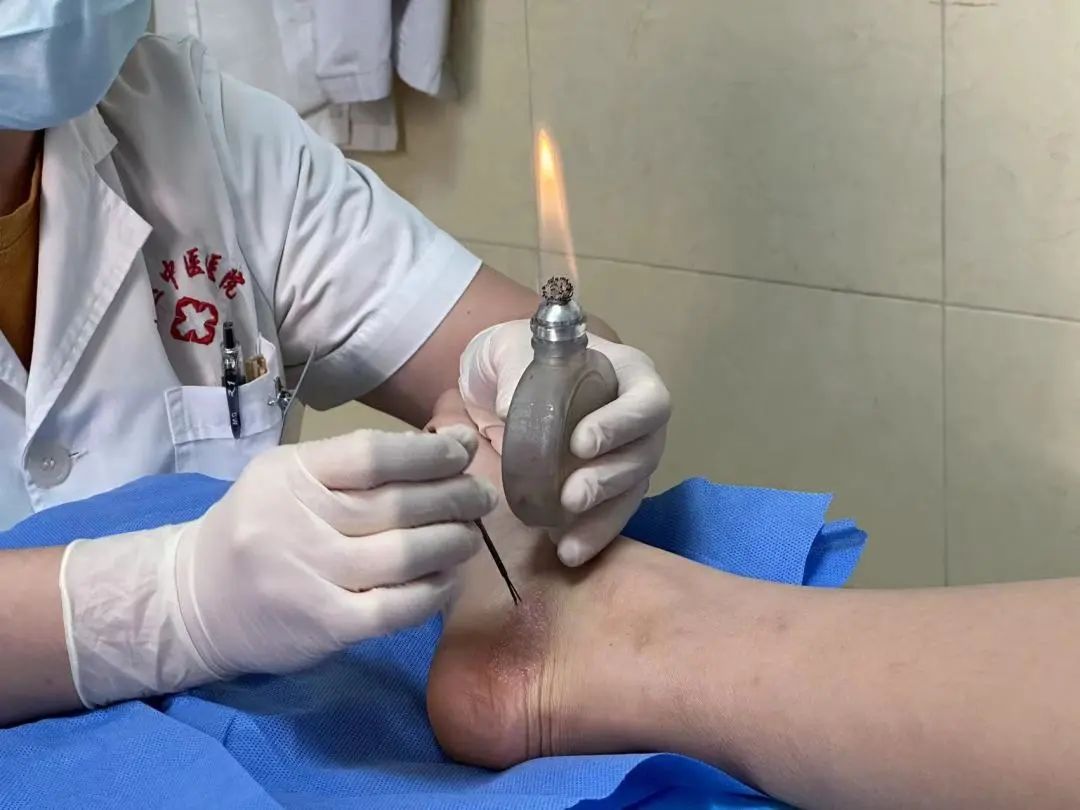 Understanding Fire Needle Therapy in Traditional Chinese Medicine