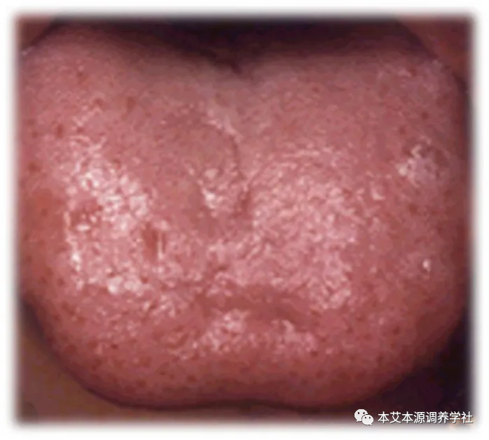Tongue Diagnosis Series 3: Precise Differentiation of Tongue Coating, Quality, and Shape