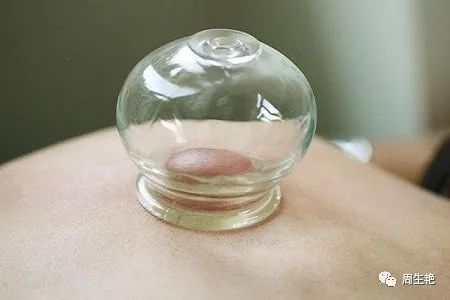 What is Cupping Therapy?