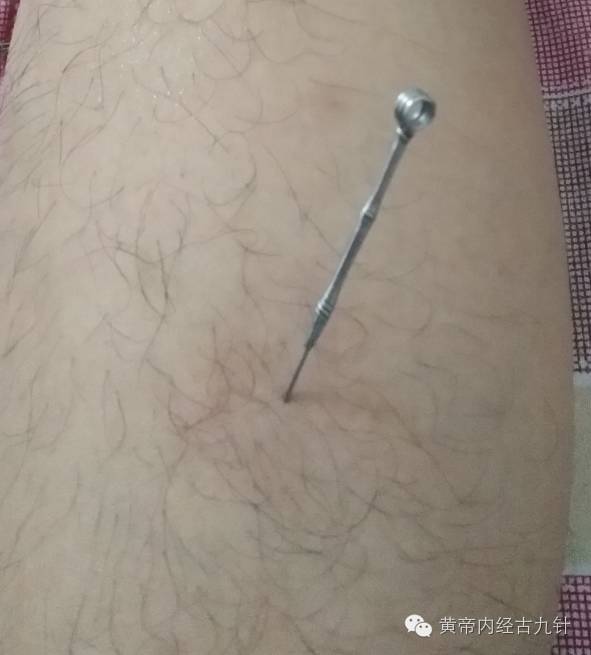 Discussion on the 'Mao Zhen' (Fine Needle) Technique