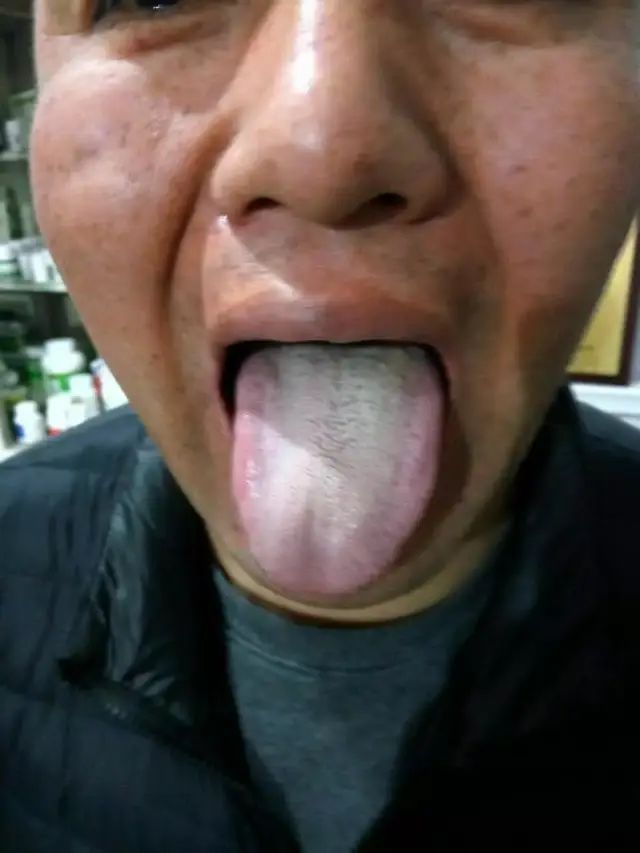 Foundations of Traditional Chinese Medicine: Phlegm-Dampness