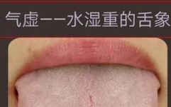 Qi Deficiency Constitution: Tongue Manifestations of Dampness and Methods for Regulation