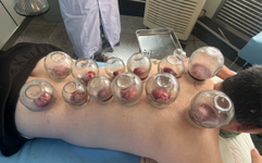 Unique TCM Therapy: Bloodletting for Pain Relief