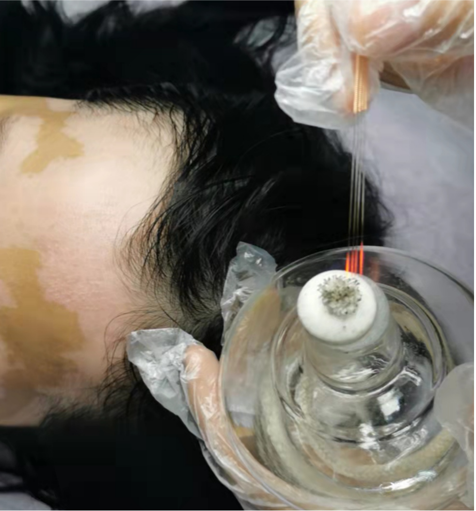 Can Fire Needling Treat Skin Diseases?