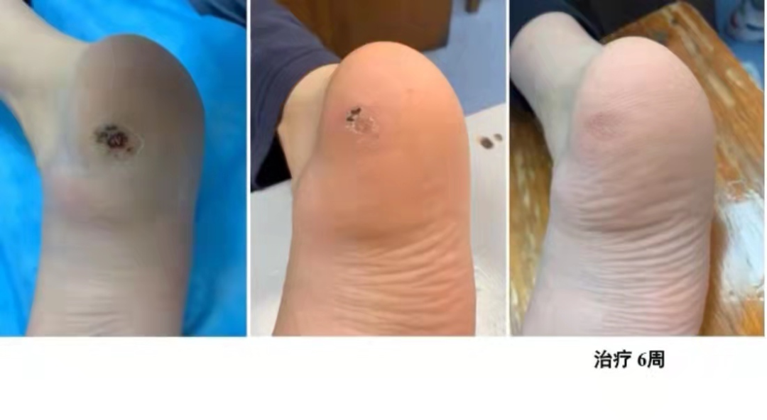 Can Fire Needling Treat Skin Diseases?