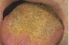 Understanding Tongue Diagnosis in Traditional Chinese Medicine (with Tongue Diagnosis Illustrations)