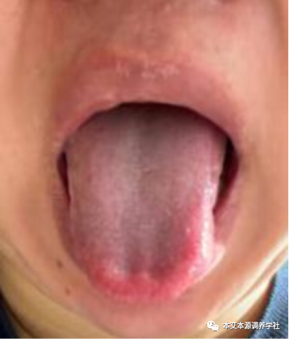 Tongue Diagnosis Series 3: Precise Differentiation of Tongue Coating, Quality, and Shape
