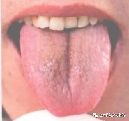 Tongue Diagnosis in Traditional Chinese Medicine: Tongue Coating