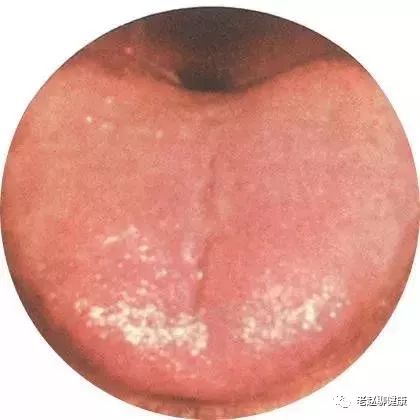 Learn Quick Ways to Observe Tongue Quality and Coating to Understand Your Health and Diseases!