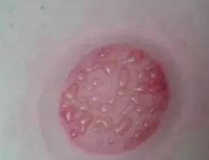 Why Cupping Can Cause Blisters and Blood Blisters