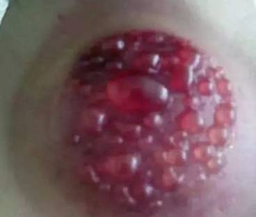 Why Cupping Can Cause Blisters and Blood Blisters
