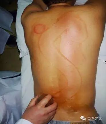 Cupping Therapy: An Art of Healing
