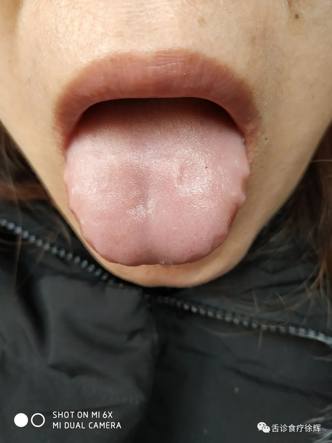 Distinguishing Between Yang Deficiency and Blood Deficiency with Pale Tongue