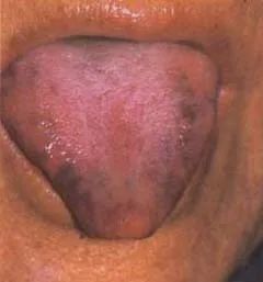 The Health Code Hidden on Your Tongue
