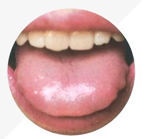 Understanding Tongue Diagnosis in TCM: Insights into Health from Tongue Appearance (Part 2)