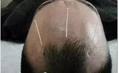 The Miraculous "Three Needles" in TCM Acupuncture: Treating One Disease with Three Acupuncture Points