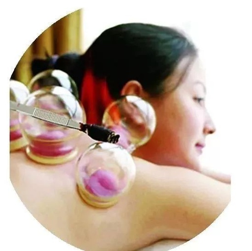 Methods of Cupping: Retention, Flash, and Sliding Techniques
