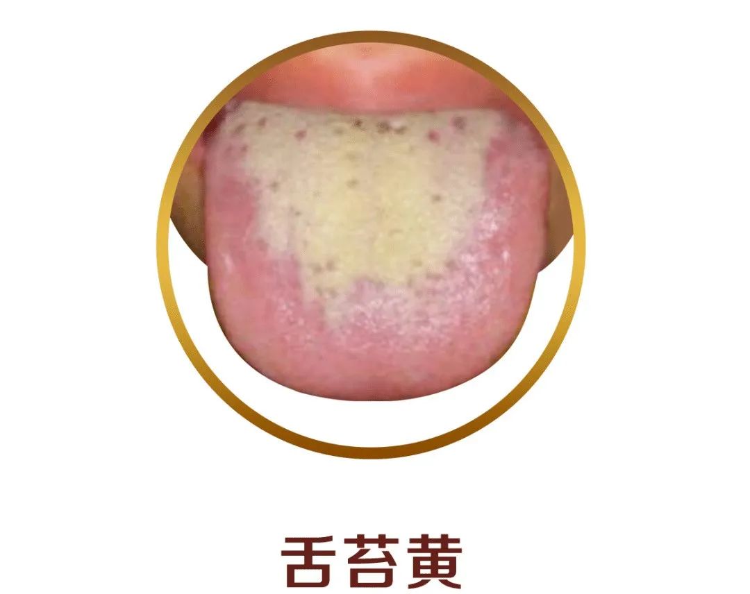 How to Observe Tongue Coating to Reflect Your Health