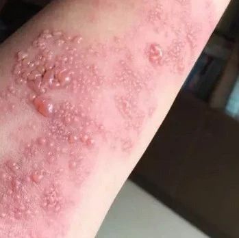 Is Your Condition Worsening After Moxibustion? Congratulations, You're One Step Closer to Recovery!
