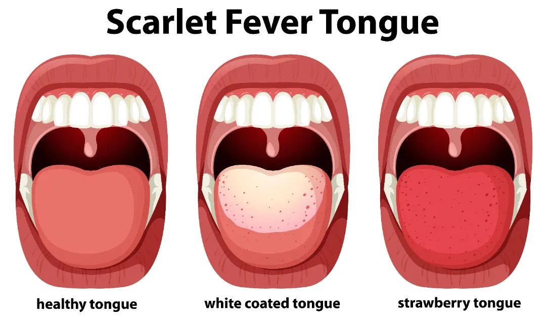 10 Types of Tongue Appearance That May Indicate Illness
