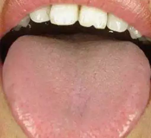 The Most Comprehensive Guide to Tongue Diagnosis! Master It and Become a Tongue Diagnosis Expert