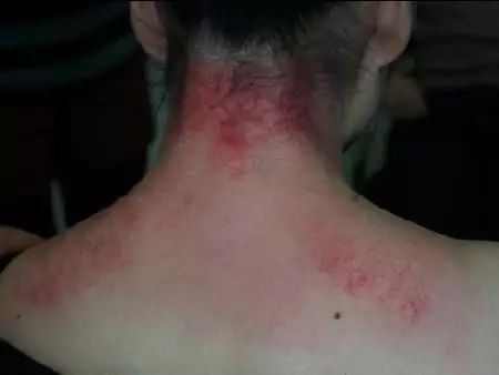 The Eight Most Common Techniques of Gua Sha and Comprehensive Analysis of Sha Patterns