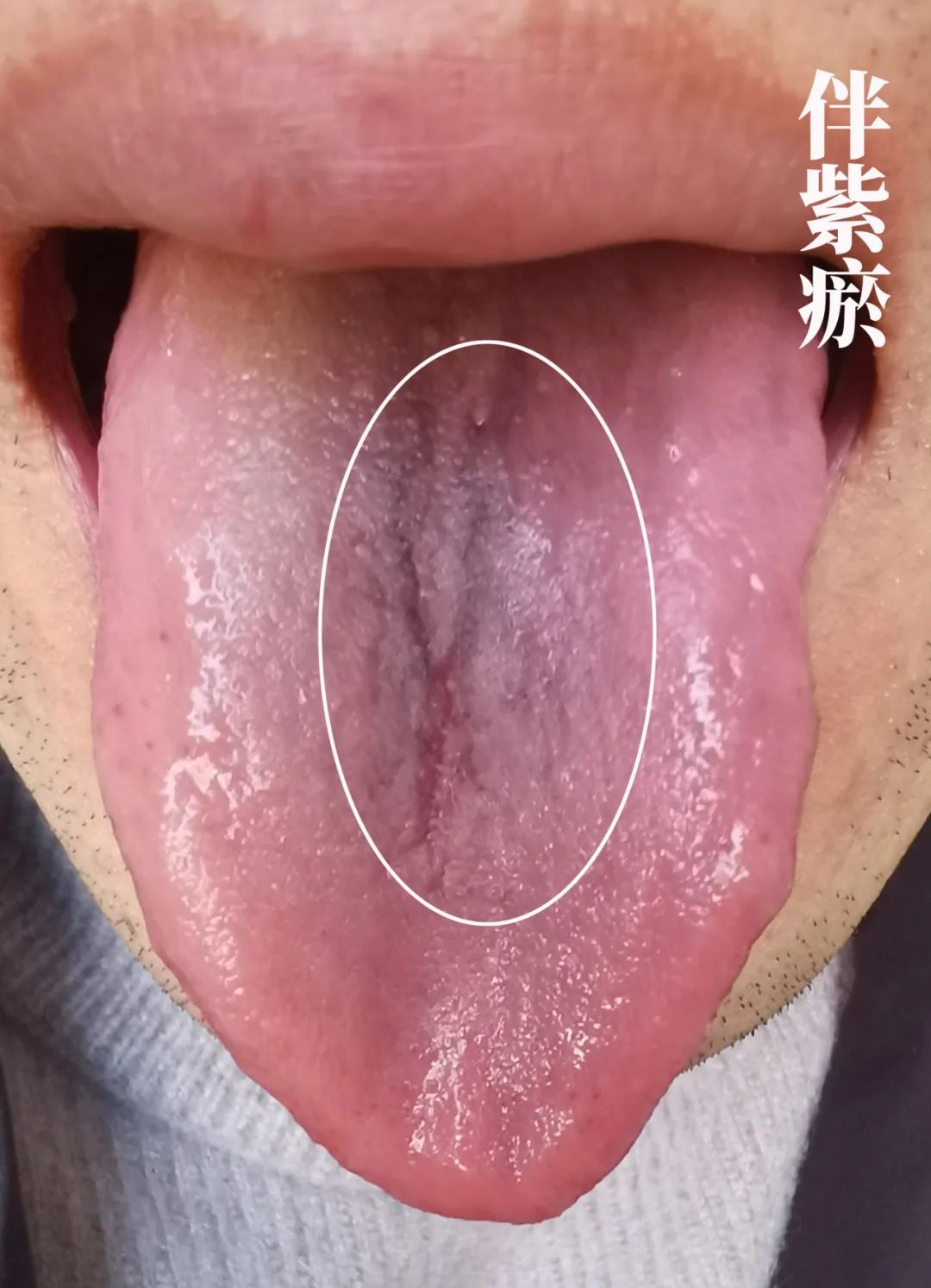 The Body Signals Illness: Understanding Tongue Diagnosis in TCM