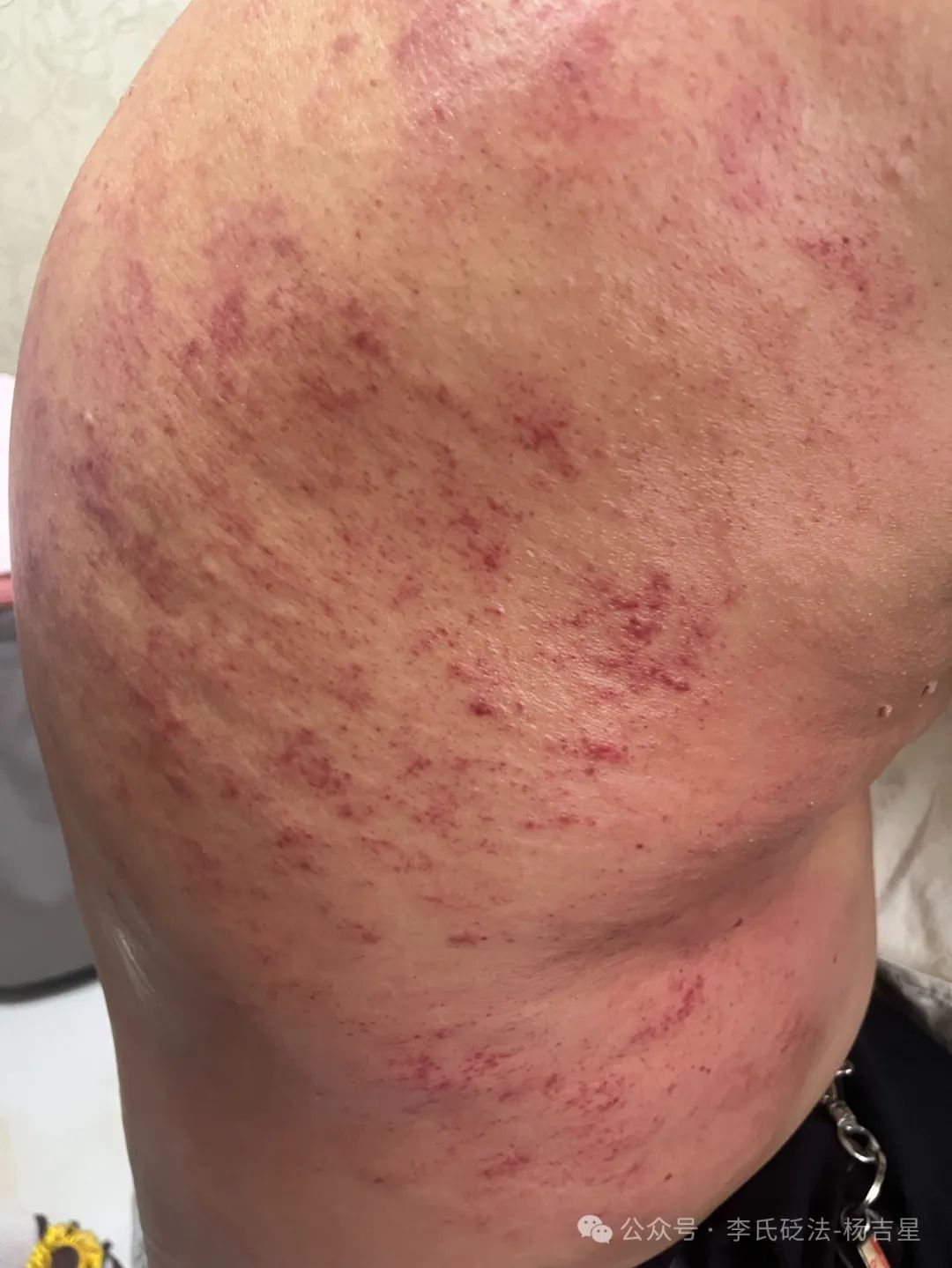 How to Use Gua Sha for Gout Management? Case Study (1)
